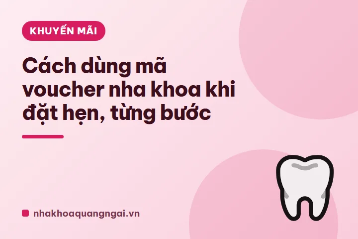 Niềng răng: những điều cần biết trước khi quyết định